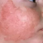 атопический дерматит на лице у ребенка